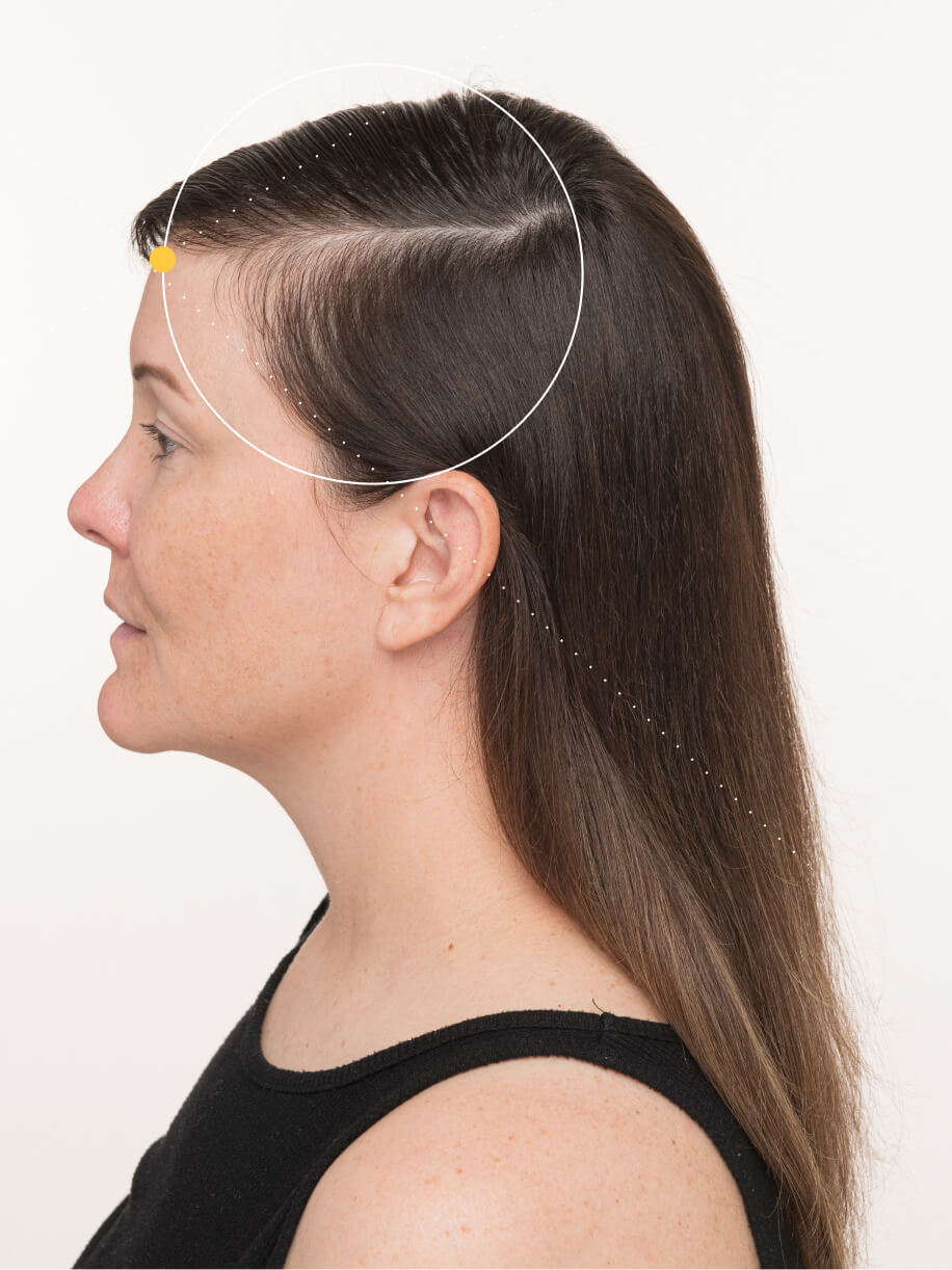 Lindsey before taking Nutrafol Women Hair Growth Nutraceutical.